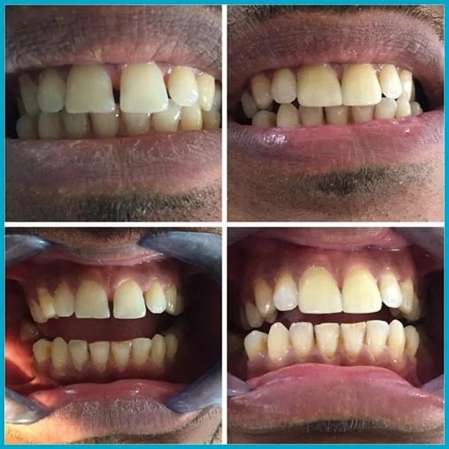 smile design treatments